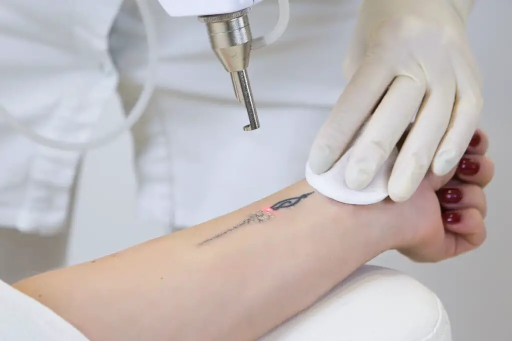 Woman undergoing tattoo removal on her wrist.