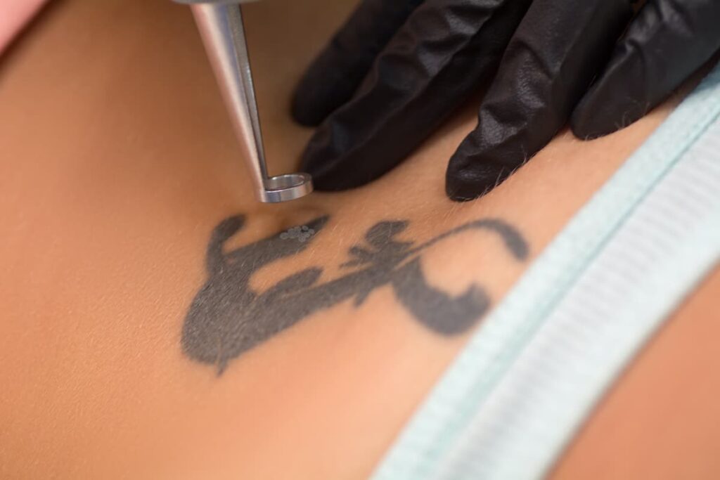 Closeup of professional tattoo removal process on a black ink tattoo.