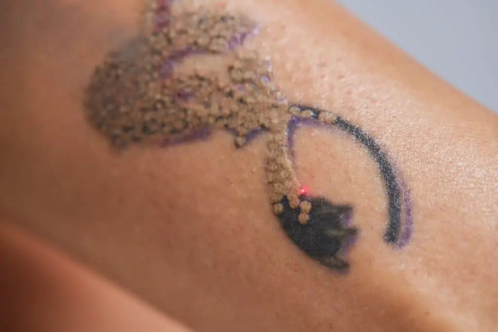 A tattoo undergoing laser removal.