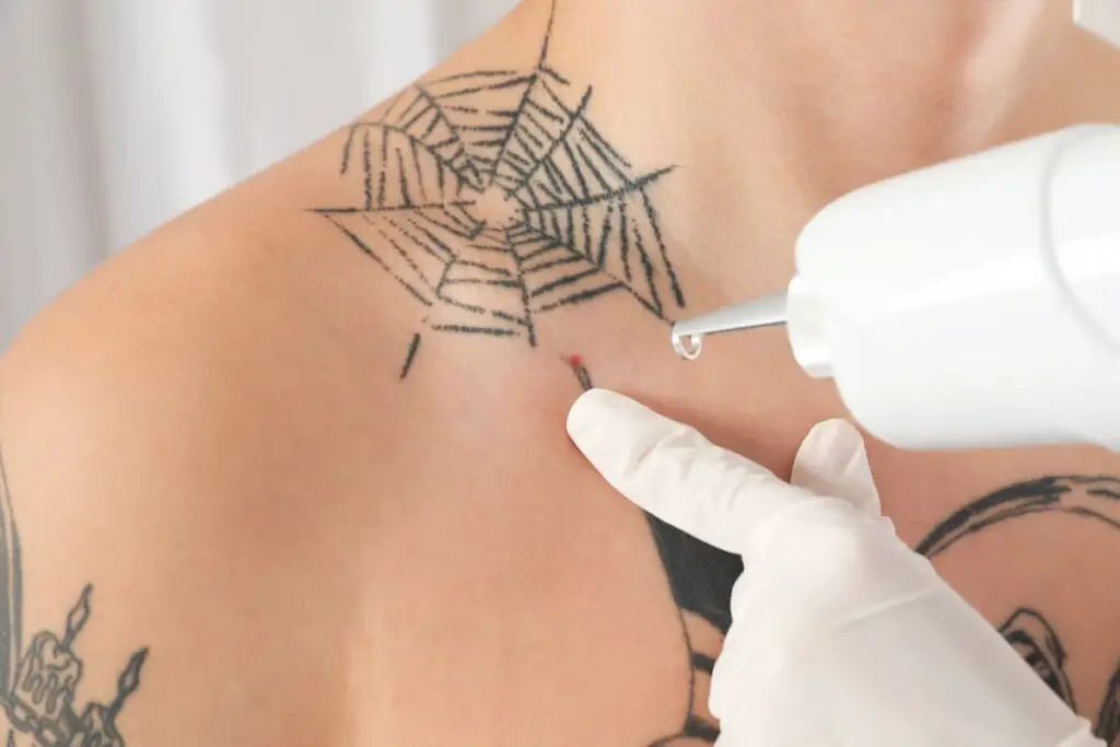 A man undergoing tattoo removal on a chest tattoo.